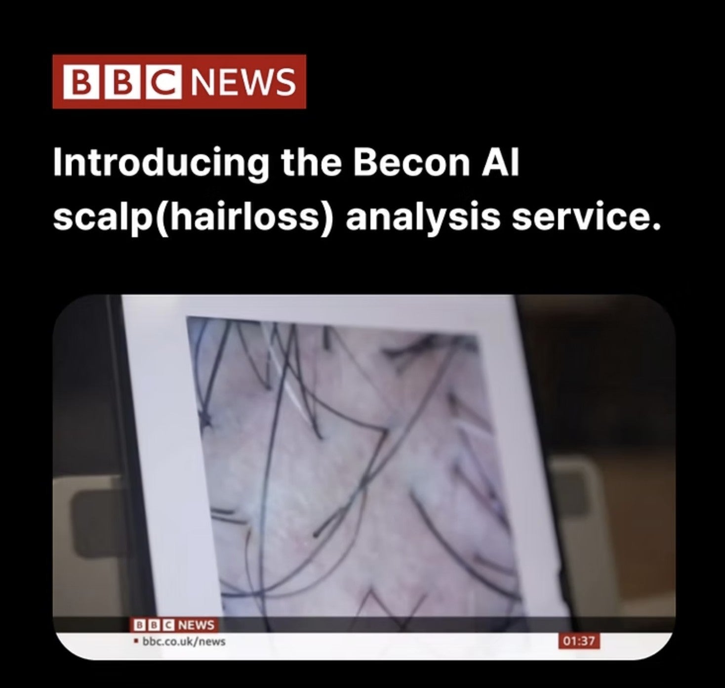 [BBC] Introducing the Becon AI scalp(hairloss) analysis service