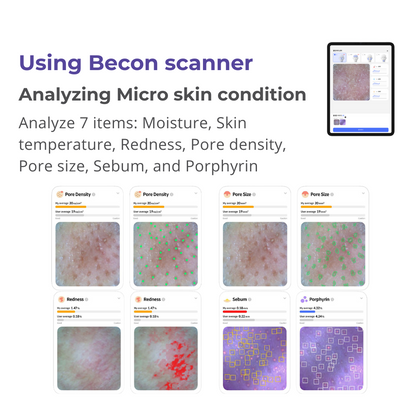 Becon AI analysis for Skin and Scalp Scanner + 1 Year Software